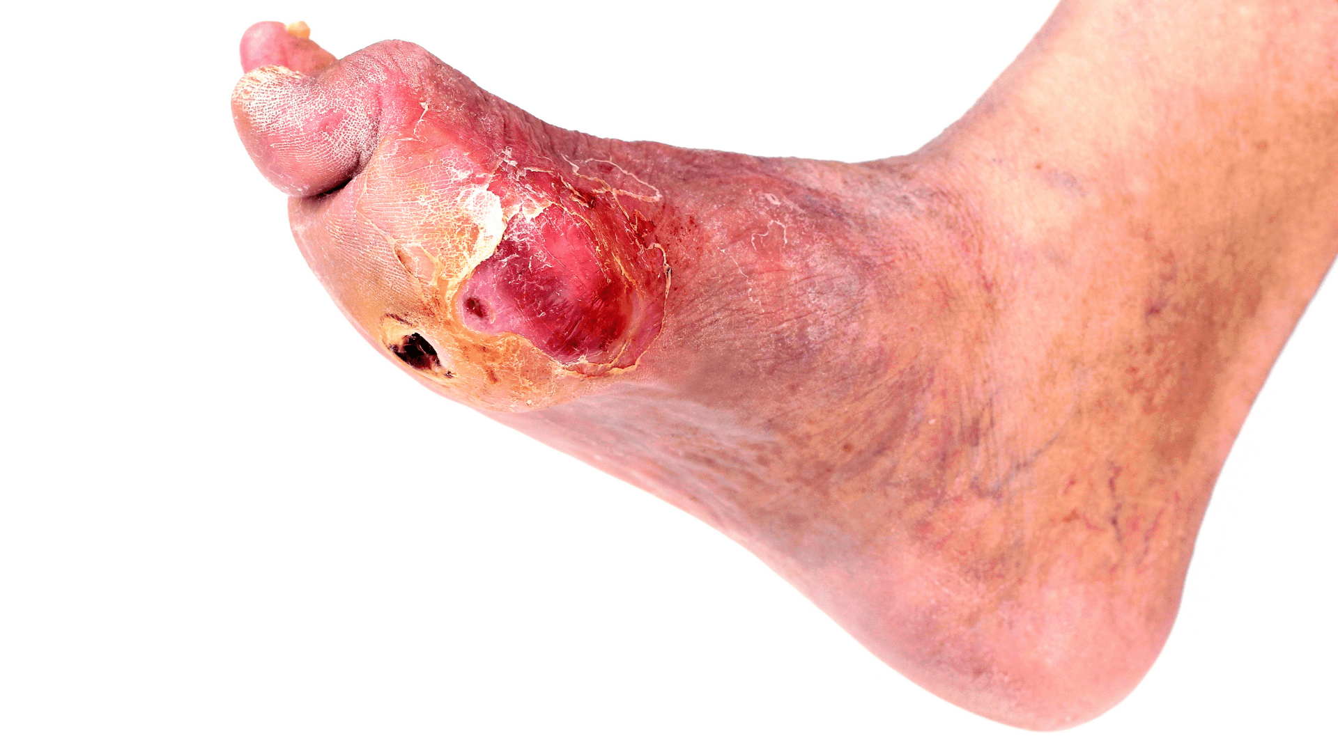 Wounded Foot